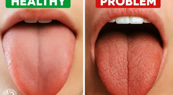 Gesunde Zunge (links) vs. Zunge mit Problemen (rechts). Tipps zur **Speichelproduktion anregen** für ein gesundes Mundgefühl.