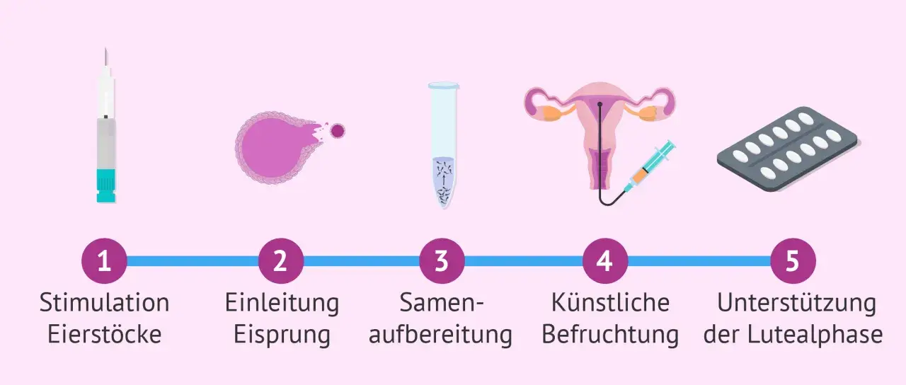 Der Insemination Ablauf: Stimulation der Eierstöcke, Eisprung-Einleitung, Samenvorbereitung, künstliche Befruchtung, Lutealphase-Unterstützung.