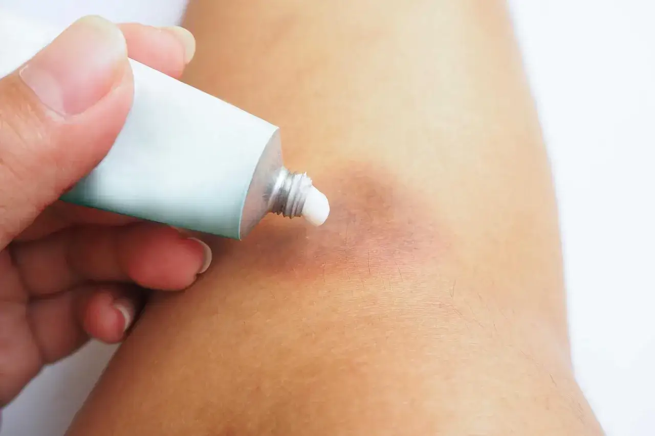 Arnika gegen blaue Flecken: Eine Hand dr&uuml;ckt eine Salbentube aus, um eine wei&szlig;e Creme auf einen blauen Fleck auf der Haut aufzutragen.