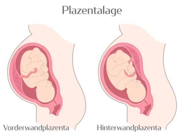 Zwei Darstellungen einer Schwangerschaft: Links eine vorderwand plazenta, rechts eine hinterwandplazenta. Der Fötus ist in beiden Fällen gut erkennbar.