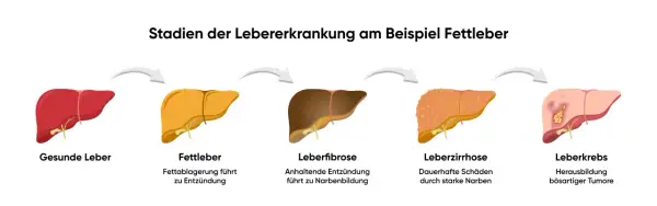 Verlauf einer Lebererkrankung: gesunde Leber, Fettleber, Leberfibrose, Leberzirrhose und Leberkrebs. Stres oksydacyjny kann diese Entwicklung beschleunigen.