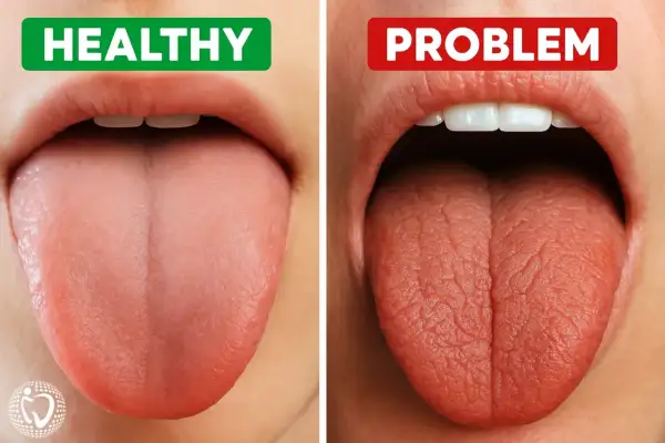 Gesunde Zunge (links) vs. Zunge mit Problemen (rechts). Tipps zur **Speichelproduktion anregen** für ein gesundes Mundgefühl.